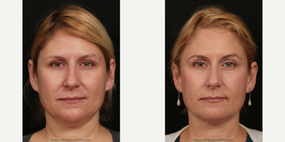 Kybella before and after photo