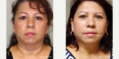 QuickLift before and after photo