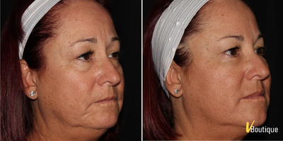 Restylane before and after photo