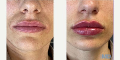 Restylane before and after photo