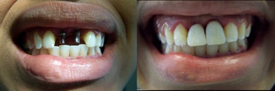 Dental Implants before and after photo