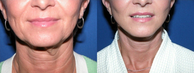 Facelift before and after photo