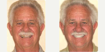 Smile Makeover before and after photo