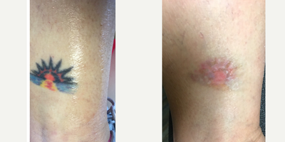 Tattoo Removal before and after photo