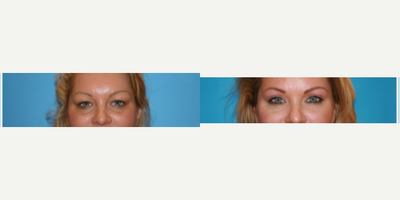 Eyelid Surgery before and after photo