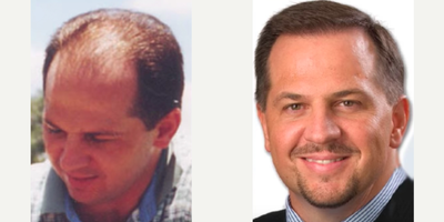 Hair Transplant before and after photo