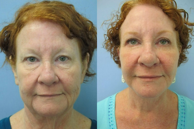 Botox before and after photo