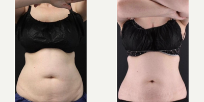 CoolSculpting before and after photo