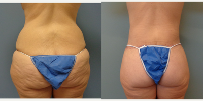 Body Lift before and after photo