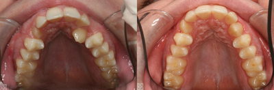 Clear Braces before and after photo