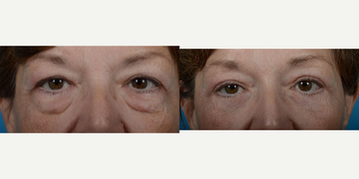 Eyelid Surgery before and after photo