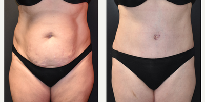Liposuction before and after photo