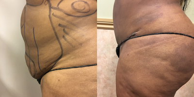 Mini Tummy Tuck before and after photo