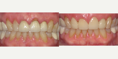 Porcelain Veneers before and after photo