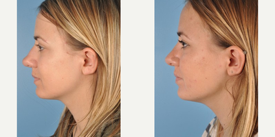 Rhinoplasty before and after photo