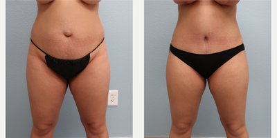 Tummy Tuck before and after photo