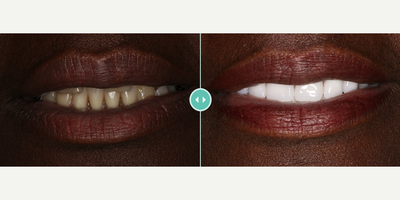 Dental Implants before and after photo
