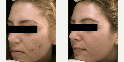 Fraxel Laser before and after photo