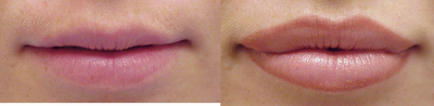 Juvederm before and after photo