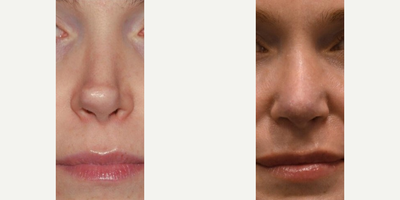 Revision Rhinoplasty before and after photo