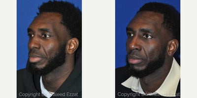 African American Rhinoplasty before and after photo