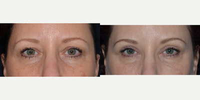 Eyelid Surgery before and after photo