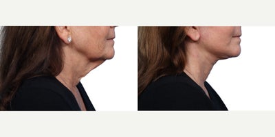 Facelift before and after photo