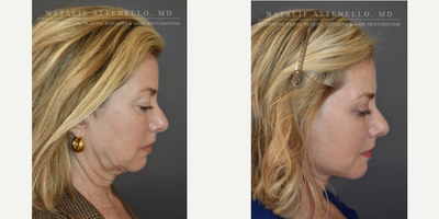 Neck Lift before and after photo