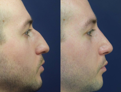 Rhinoplasty before and after photo