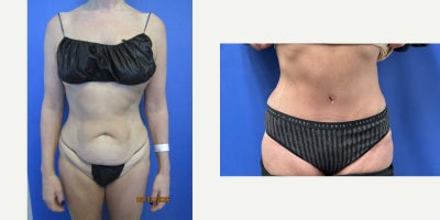 Tummy Tuck before and after photo