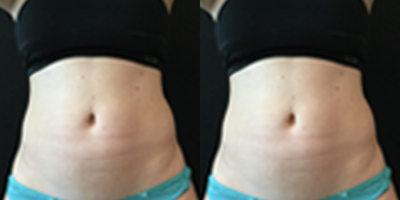 CoolSculpting before and after photo