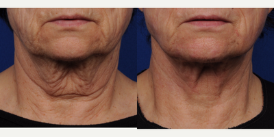 Laser Liposuction before and after photo