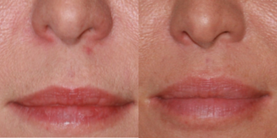 Lip Lift before and after photo