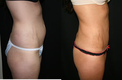 Mini Tummy Tuck before and after photo