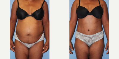 Tummy Tuck before and after photo