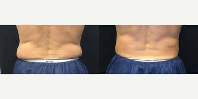CoolSculpting before and after photo