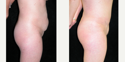 Drainless Tummy Tuck before and after photo