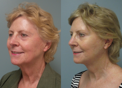 Facelift before and after photo