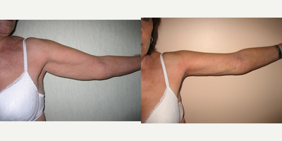 Arm Lift before and after photo