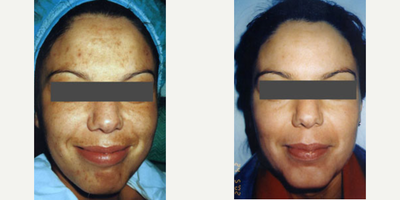 Chemical Peel before and after photo