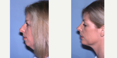 Chin Implant before and after photo