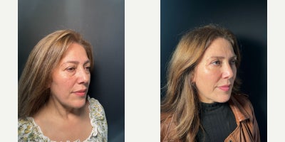 Double Eyelid Surgery before and after photo