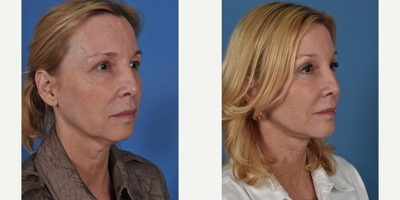 Facelift before and after photo