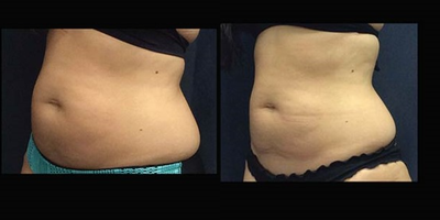 SculpSure before and after photo