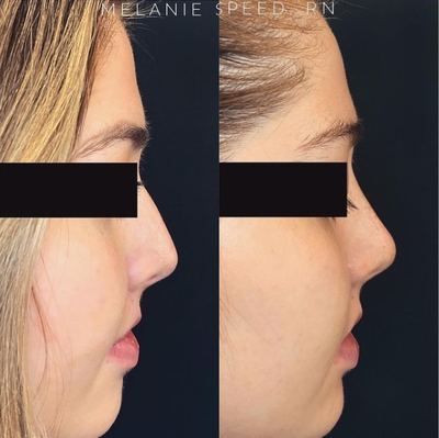 Juvederm before and after photo