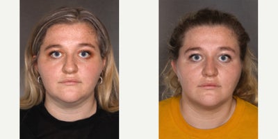 Rhinoplasty before and after photo