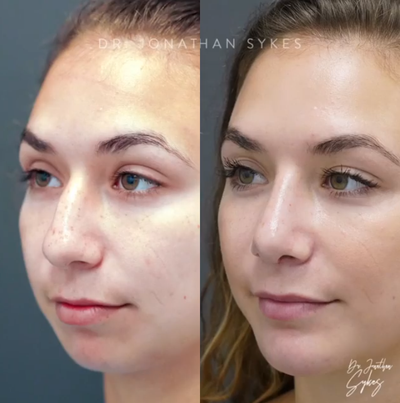 Septoplasty before and after photo
