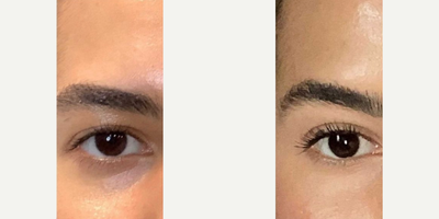 Botox before and after photo