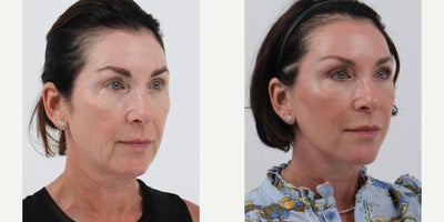 Brow Lift before and after photo