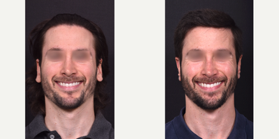 Earlobe Repair before and after photo